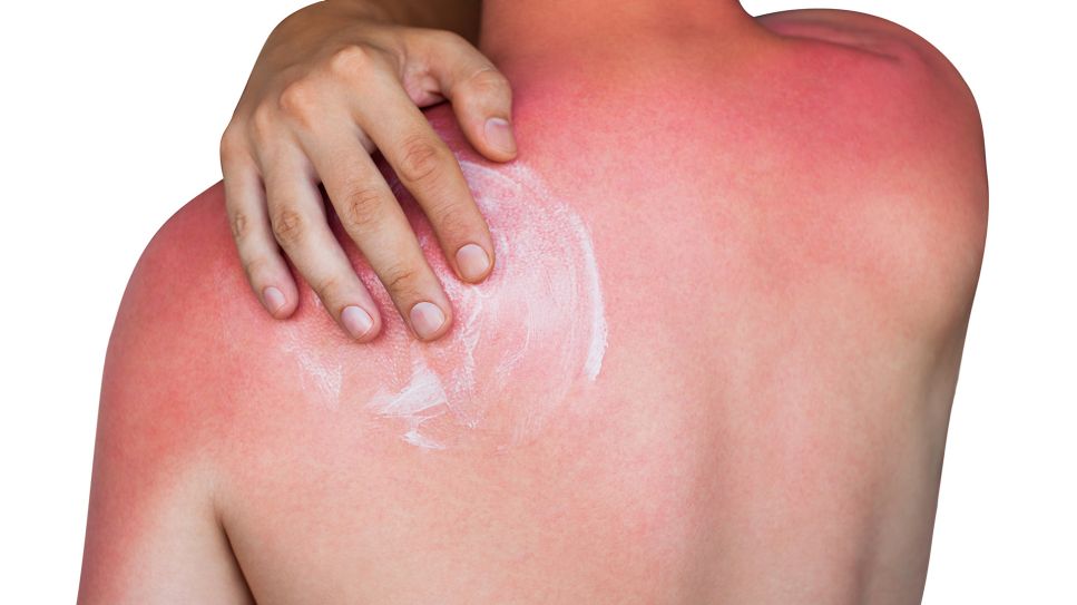 Sonnenbrand: Hautschäden erkennen & verhindern